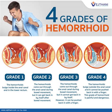 how to treat a hemorrhoid on the outside.